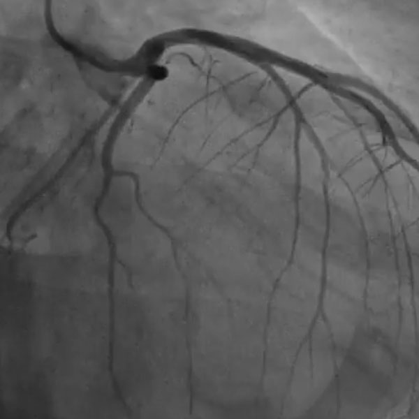 Angiografía y angioplastia coronaria